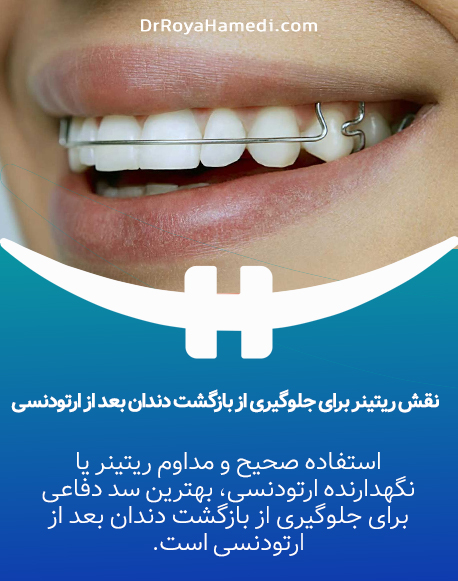 نقش نگهدارنده ارتودنسی برای جلوگیری از برگشت دندان‌ها