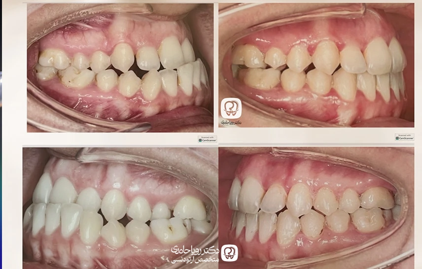 نمونه کار قبل و بعد متخصص ارتودنسی در قلهک