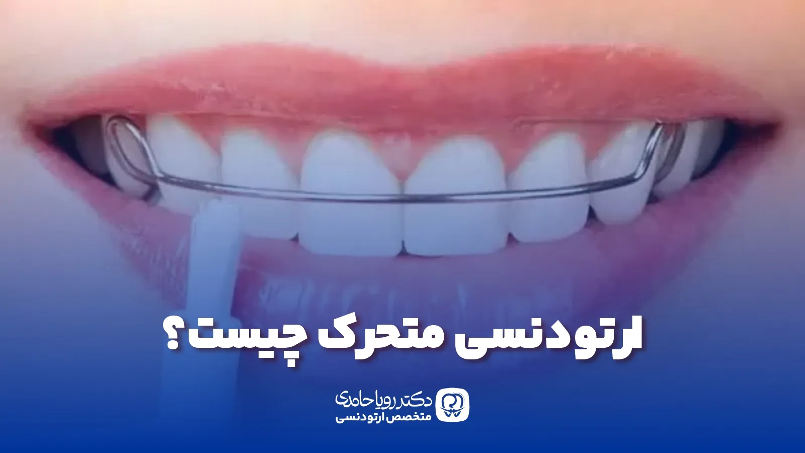 ارتودنسی متحرک