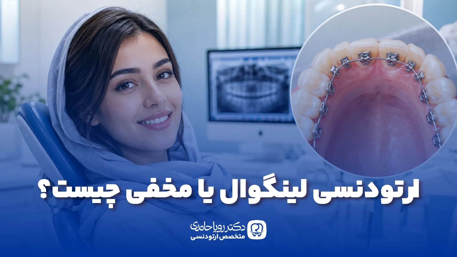Lingual orthodontics 1