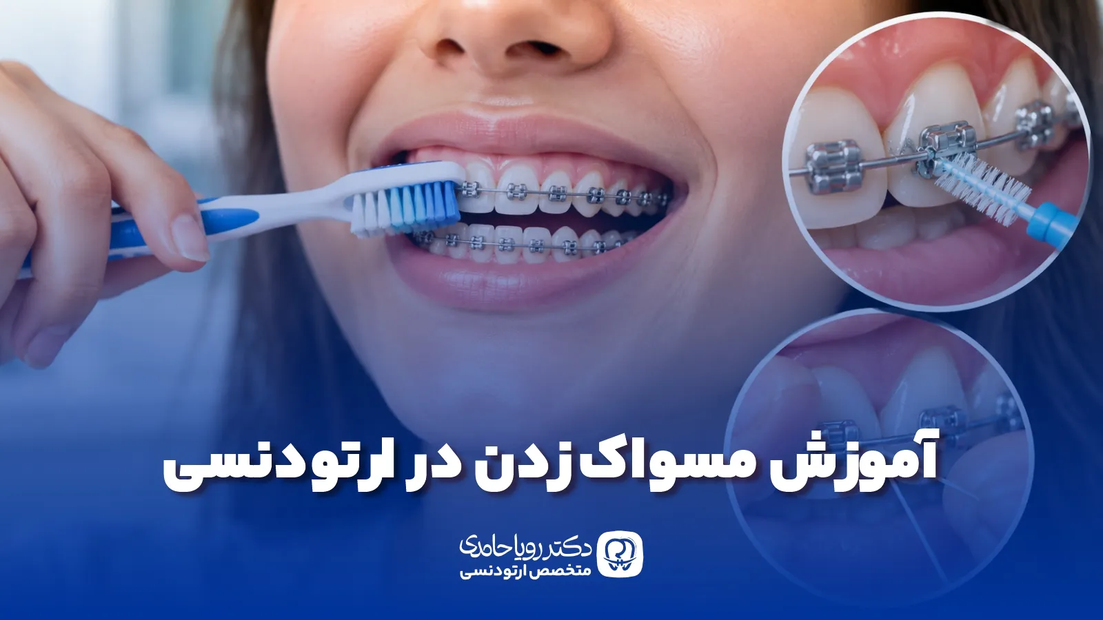 Brushing Techniques for Orthodontic Patients