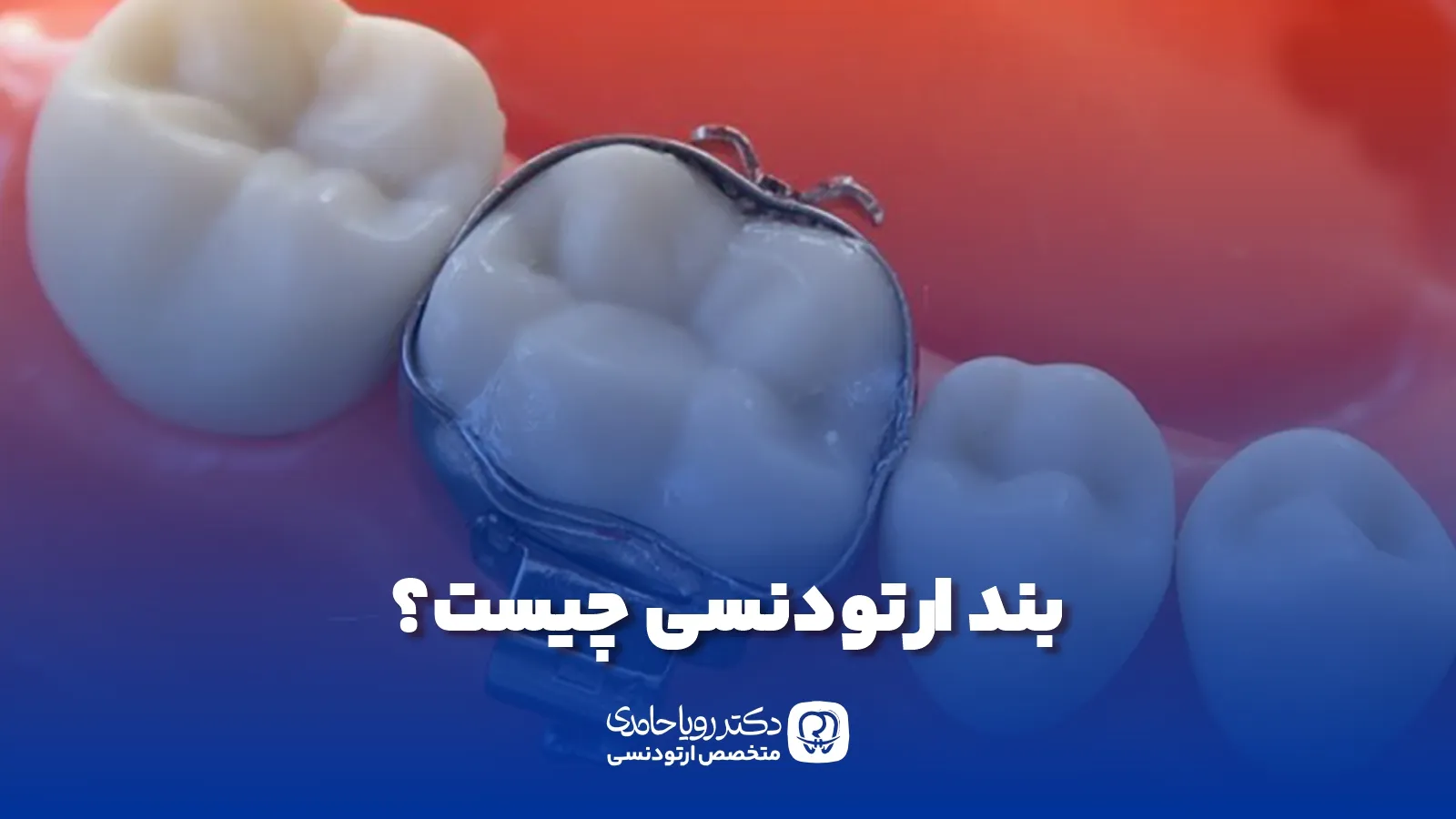 Orthodontic band