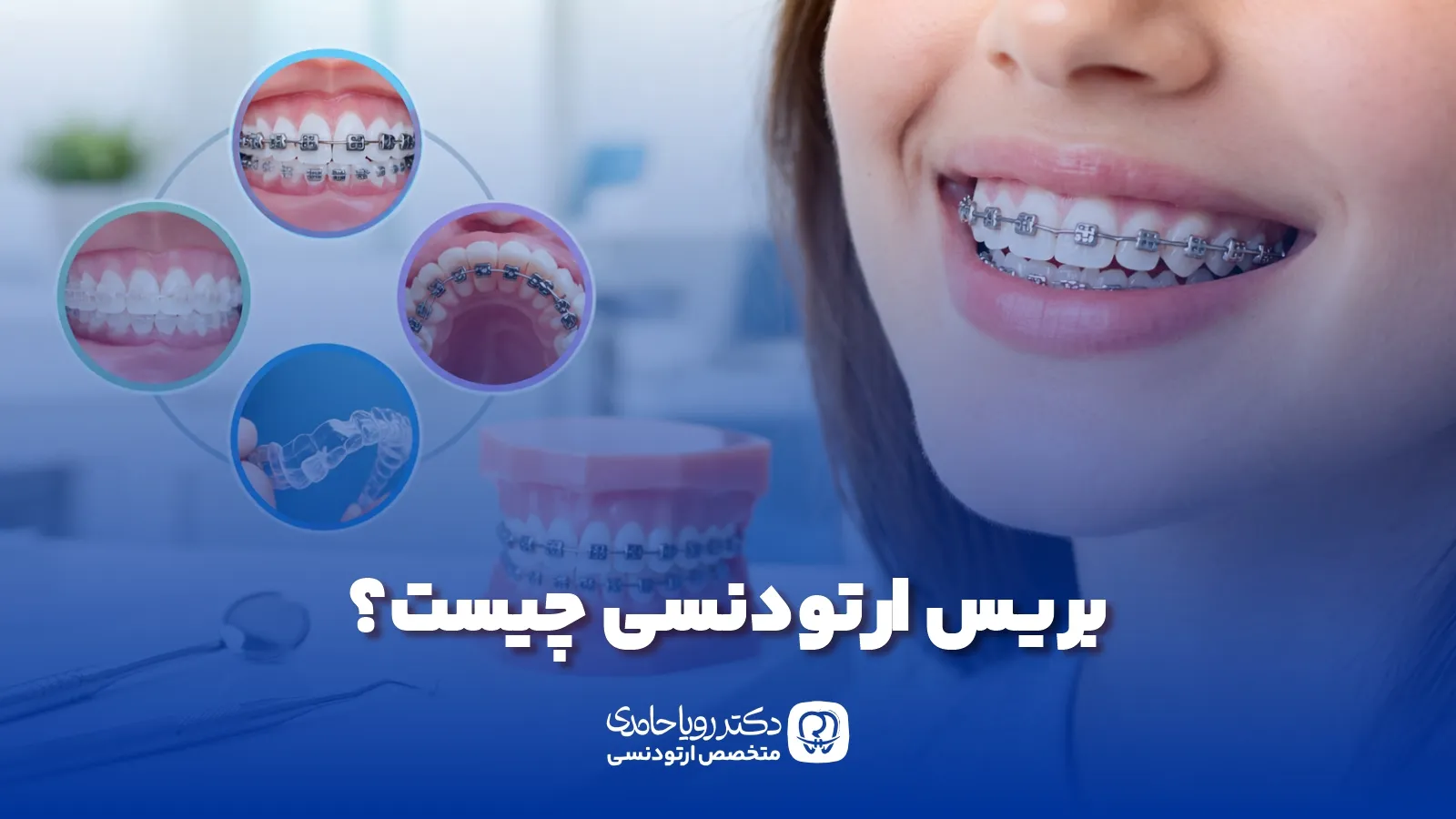 بریس ارتودنسی