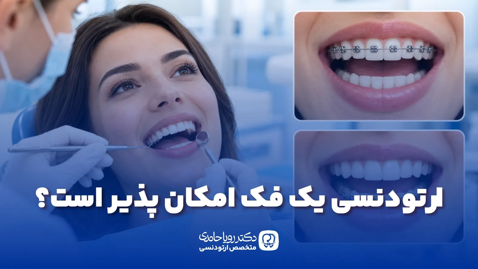 Orthodontics of one jaw alone