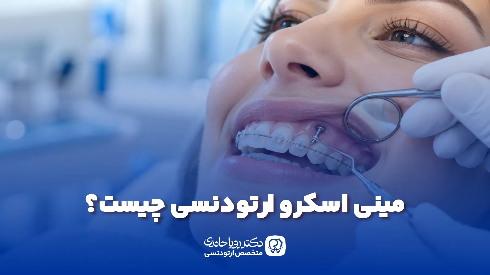 مینی اسکرو ارتودنسی